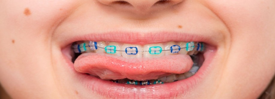 Different Types of Dental Braces Cover Image